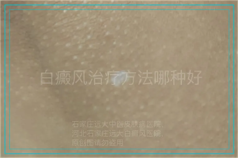 白癜风治疗方法哪种好