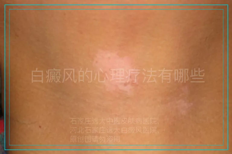 白癜风的心理疗法有哪些