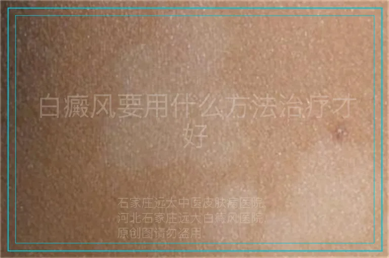 白癜风要用什么方法治疗才好