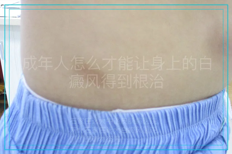 成年人怎么才能让身上的白癜风得到根治