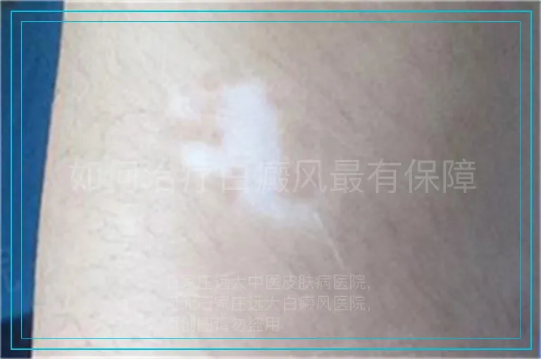 如何治疗白癜风最有保障