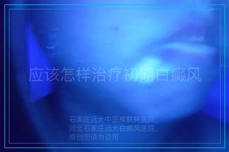 应该怎样治疗初期白癜风