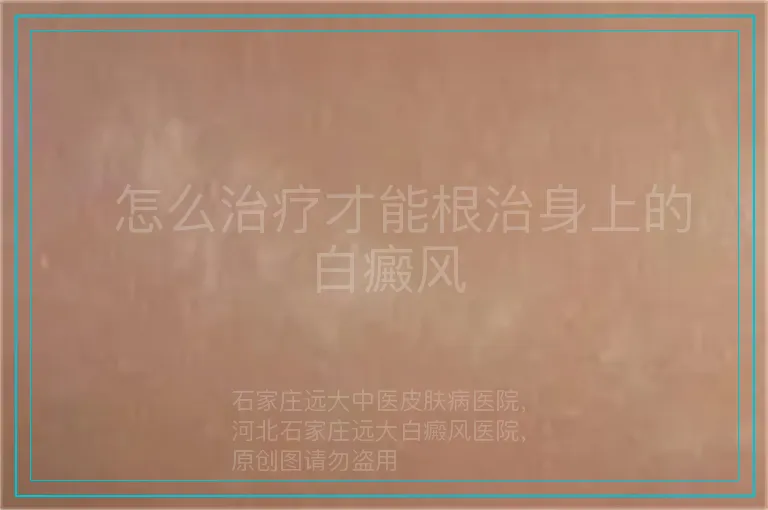   怎么治疗才能根治身上的白癜风