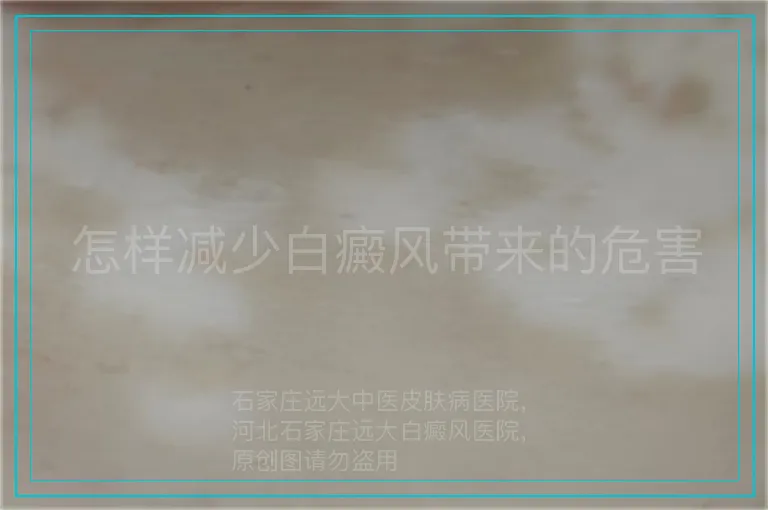 怎样减少白癜风带来的危害