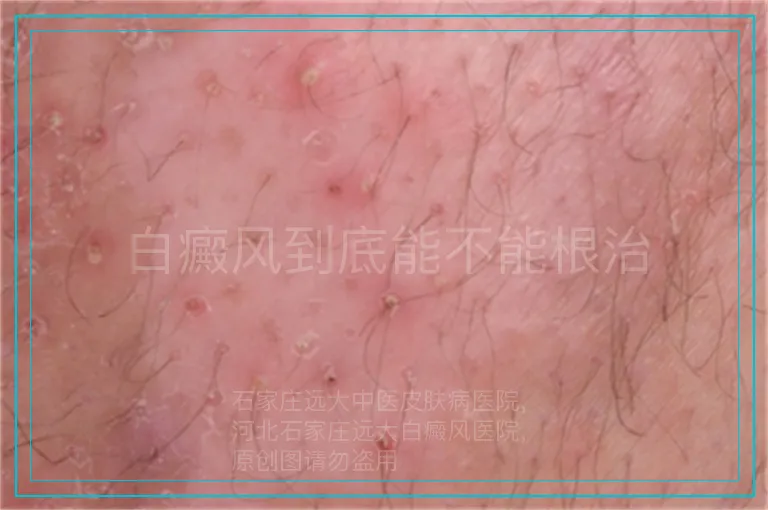 白癜风到底能不能根治