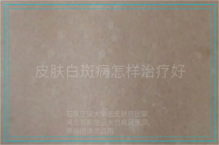 皮肤白斑病怎样治疗好