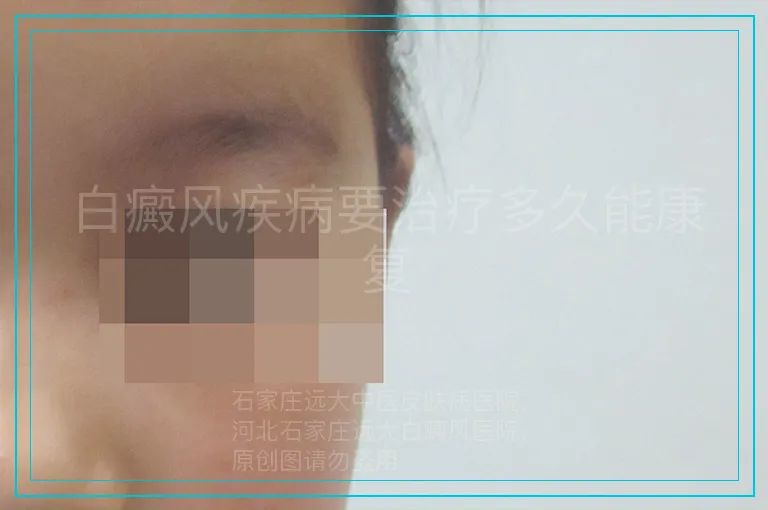 白癜风疾病要治疗多久能康复
