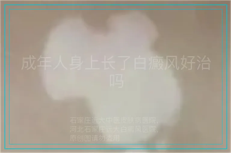成年人身上长了白癜风好治吗