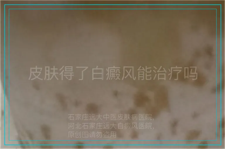 皮肤得了白癜风能治疗吗