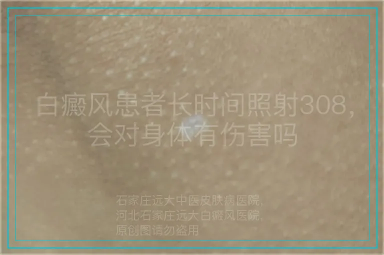 白癜风患者长时间照射308,会对身体有伤害吗