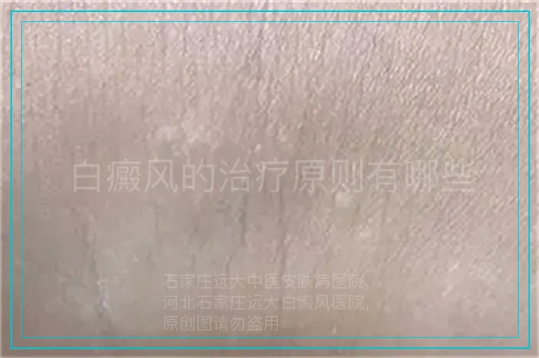 白癜风的治疗原则有哪些