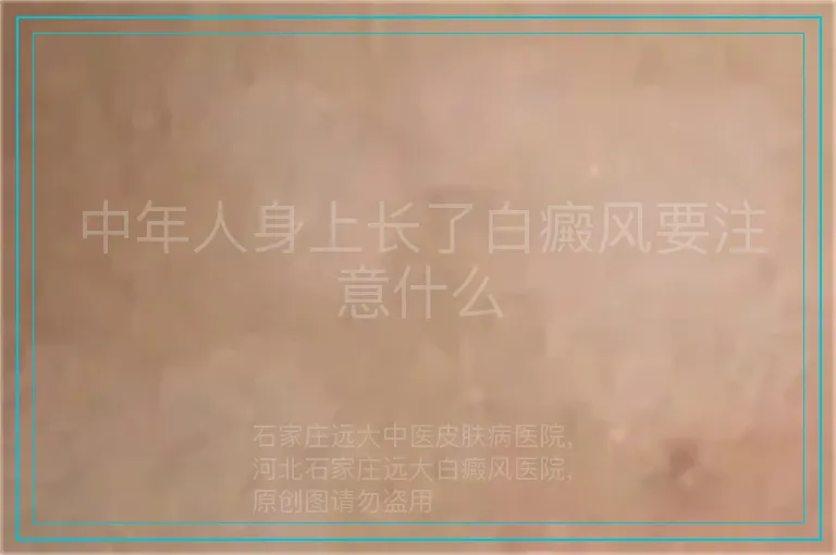 中年人身上长了白癜风要注意什么