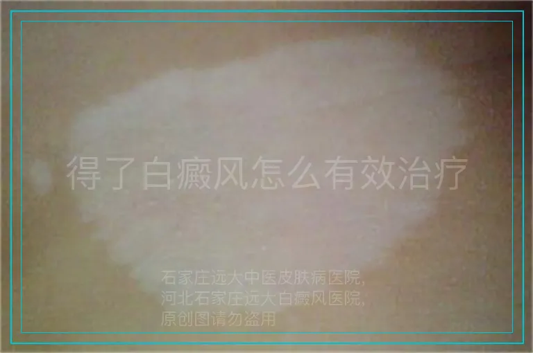 得了白癜风怎么有效治疗