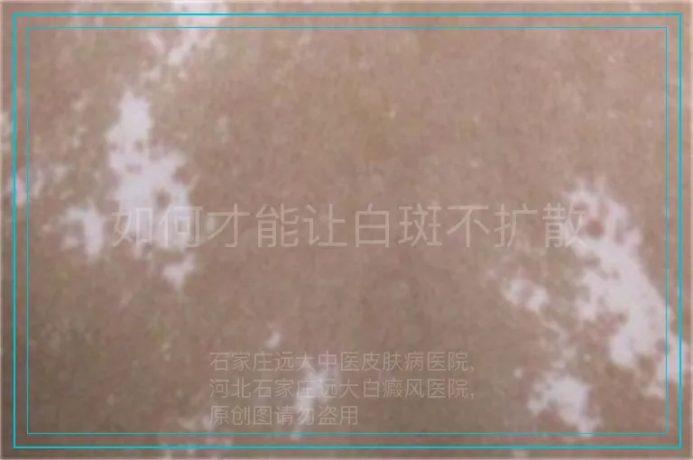如何才能让白斑不扩散