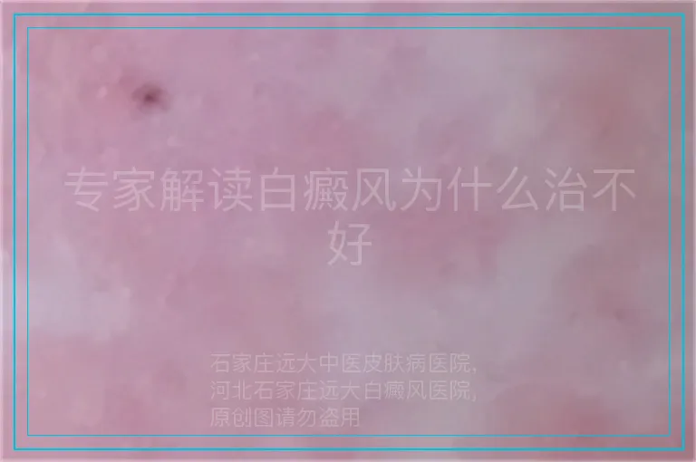 专家解读白癜风为什么治不好