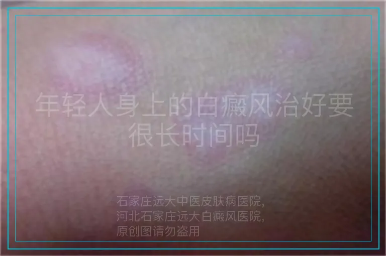 年轻人身上的白癜风治好要很长时间吗