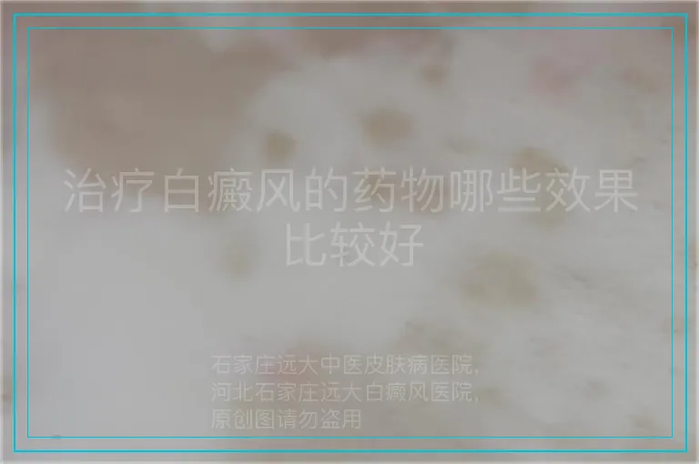 治疗白癜风的药物哪些效果比较好