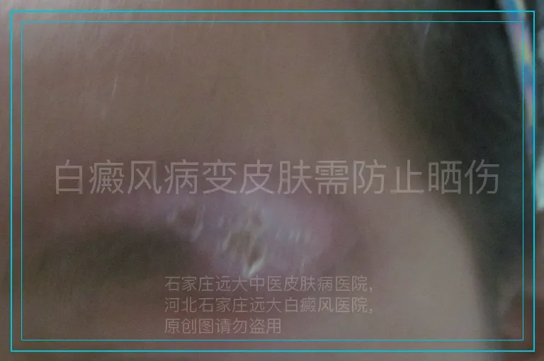 白癜风病变皮肤需防止晒伤
