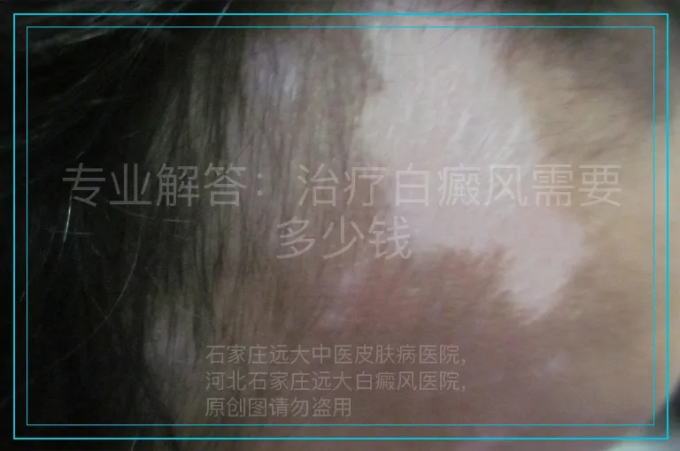 专业解答:治疗白癜风需要多少钱