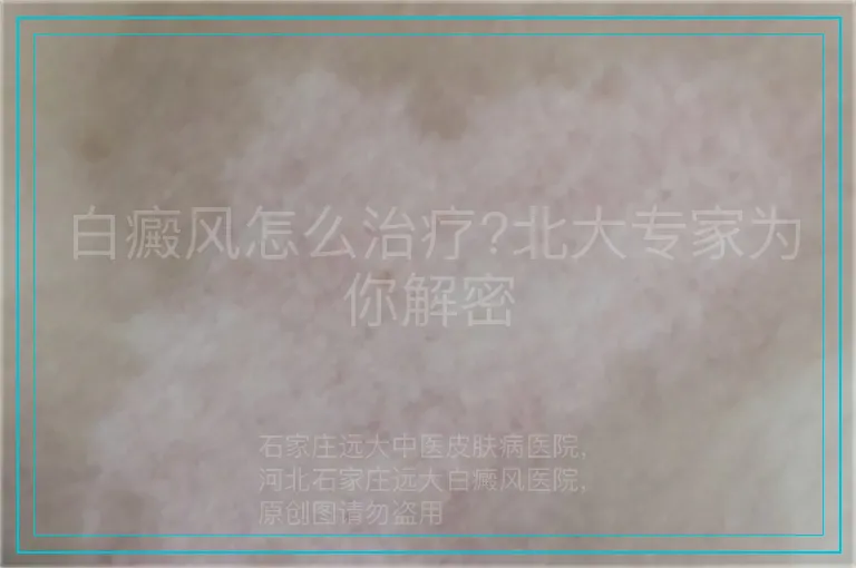 白癜风怎么治疗?北大专家为你解密