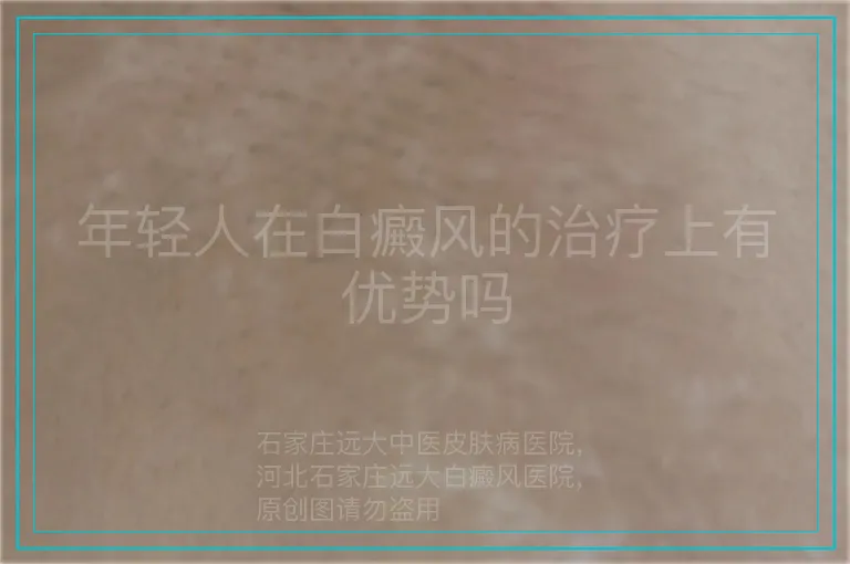 年轻人在白癜风的治疗上有优势吗