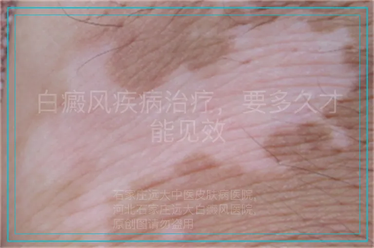 白癜风疾病治疗，要多久才能见效