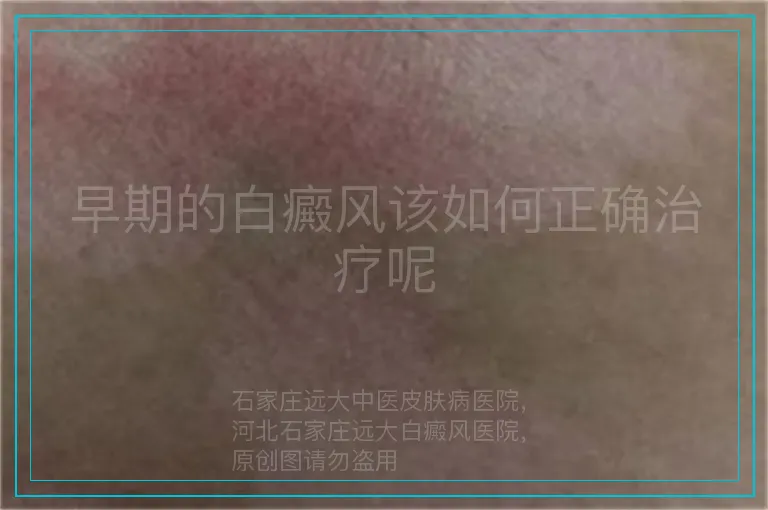 早期的白癜风该如何正确治疗呢
