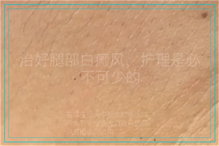 治好腿部白癜风,护理是必不可少的