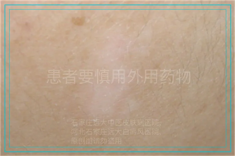 患者要慎用外用药物