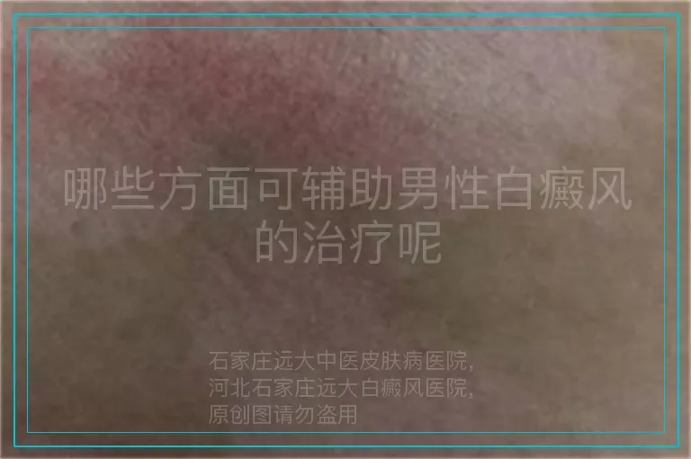 哪些方面可辅助男性白癜风的治疗呢