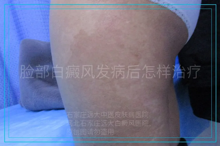脸部白癜风发病后怎样治疗