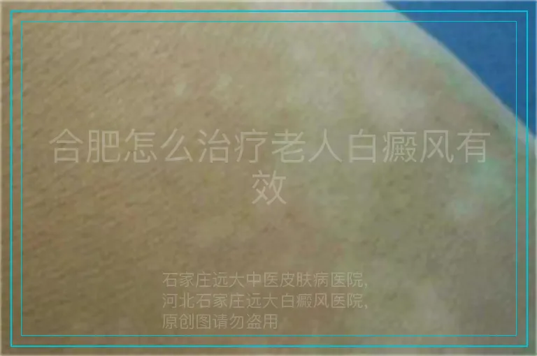 合肥怎么治疗老人白癜风有效