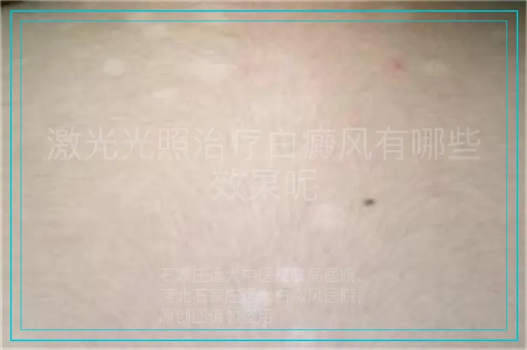 激光光照治疗白癜风有哪些效果呢