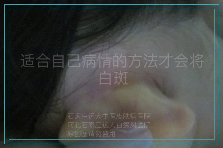 适合自己病情的方法才会将白斑