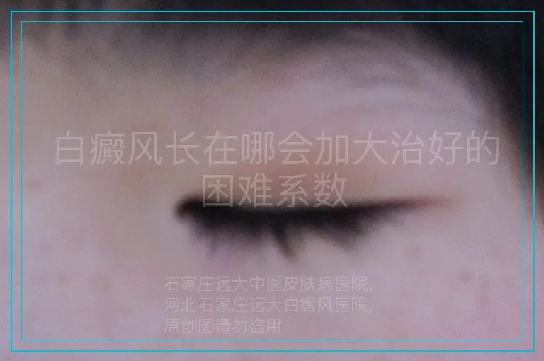 白癜风长在哪会加大治好的困难系数