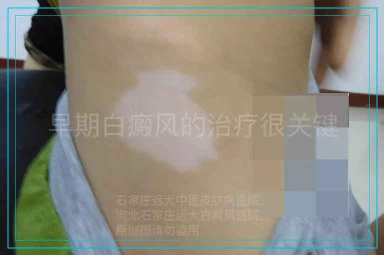 早期白癜风的治疗很关键