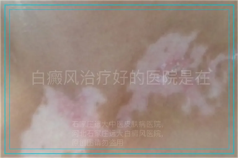 白癜风治疗好的医院是在