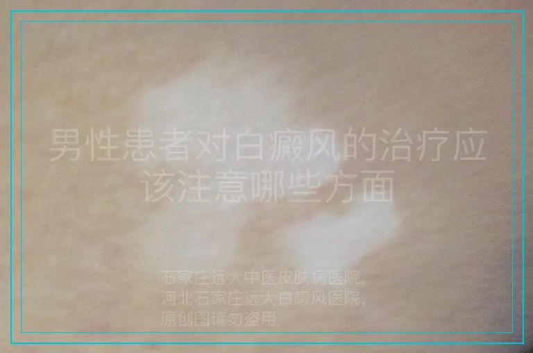 男性患者对白癜风的治疗应该注意哪些方面
