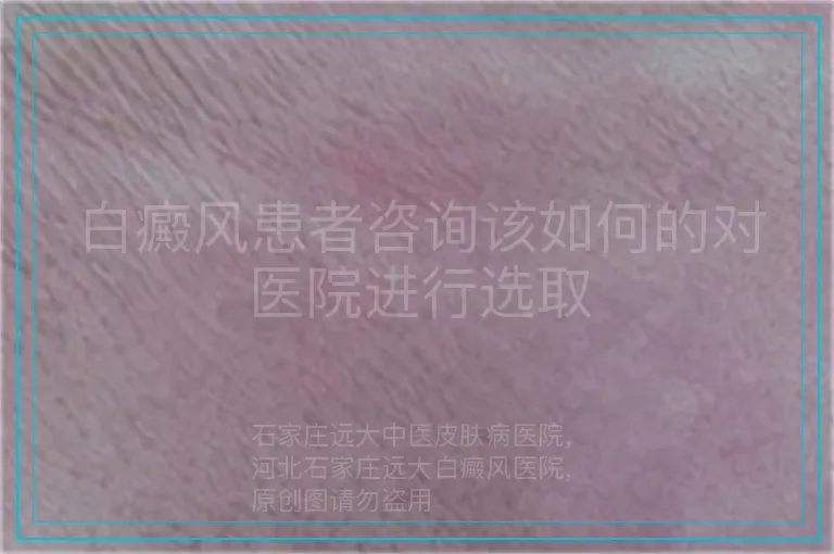 白癜风患者咨询该如何的对医院进行选取