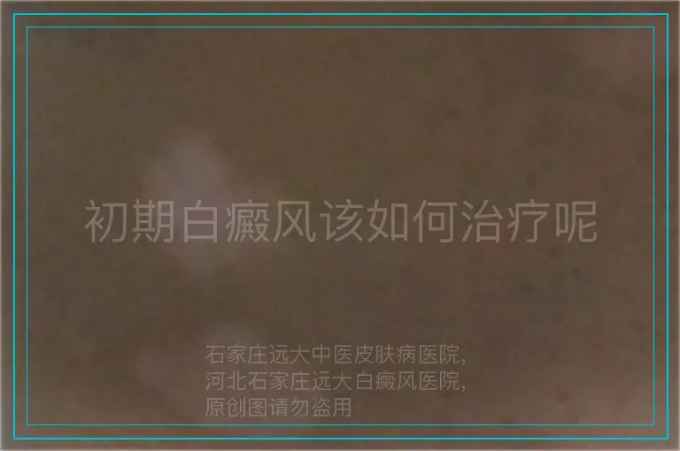 初期白癜风该如何治疗呢