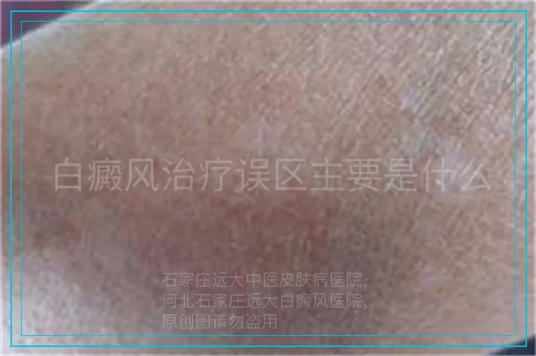 白癜风治疗误区主要是什么
