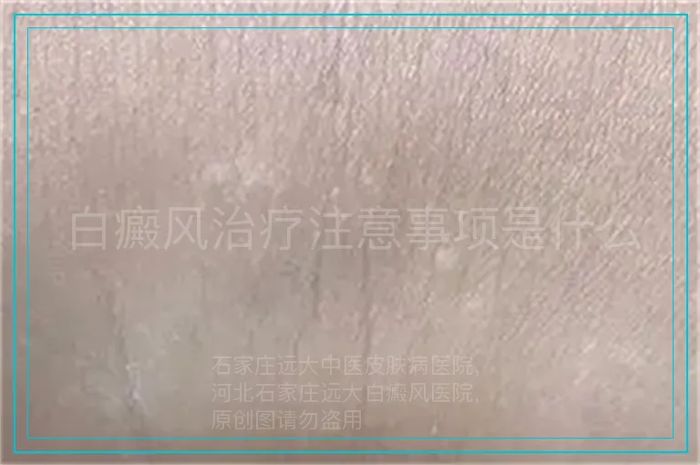 白癜风治疗注意事项是什么