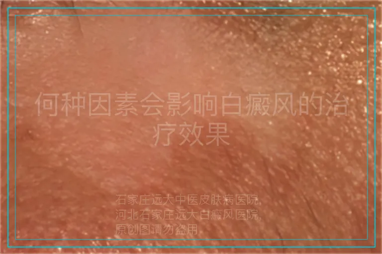 何种因素会影响白癜风的治疗效果