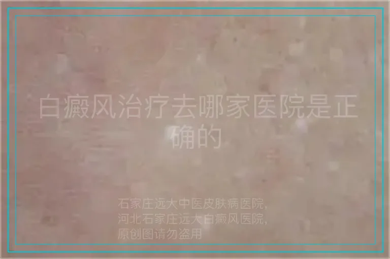 白癜风治疗去哪家医院是正确的