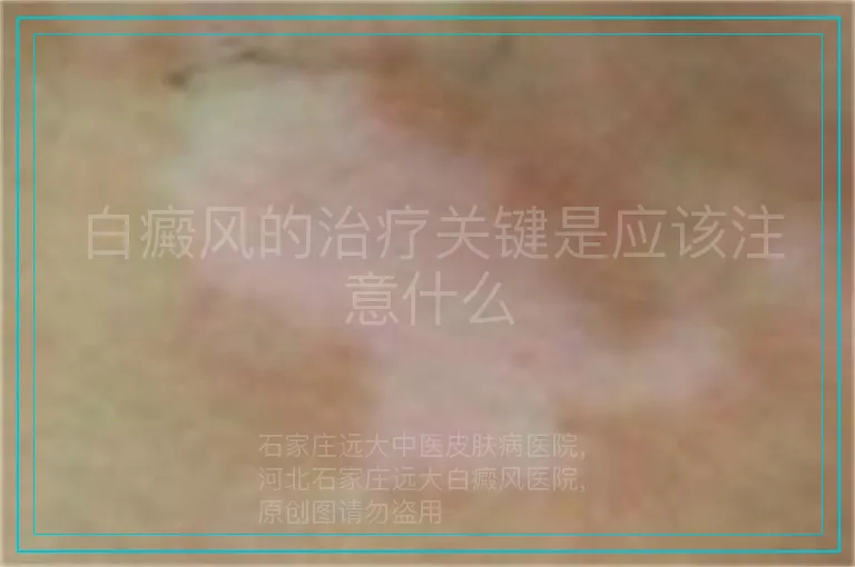 白癜风的治疗关键是应该注意什么