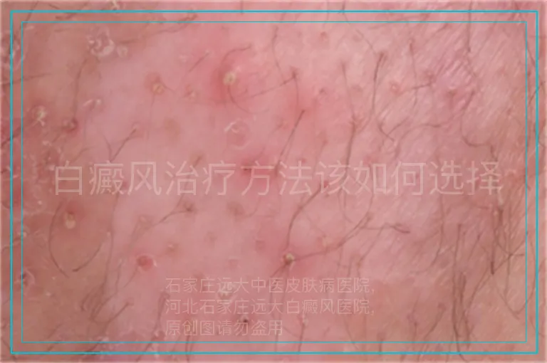 白癜风治疗方法该如何选择