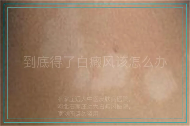 到底得了白癜风该怎么办