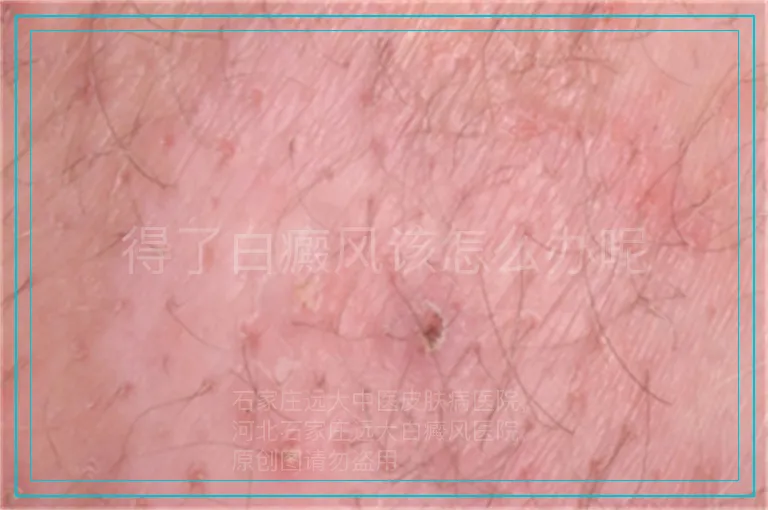 得了白癜风该怎么办呢