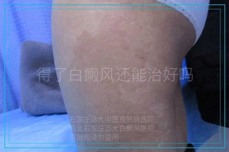 得了白癜风还能治好吗