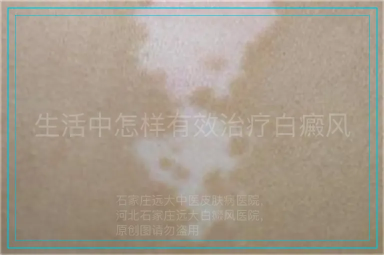 生活中怎样有效治疗白癜风